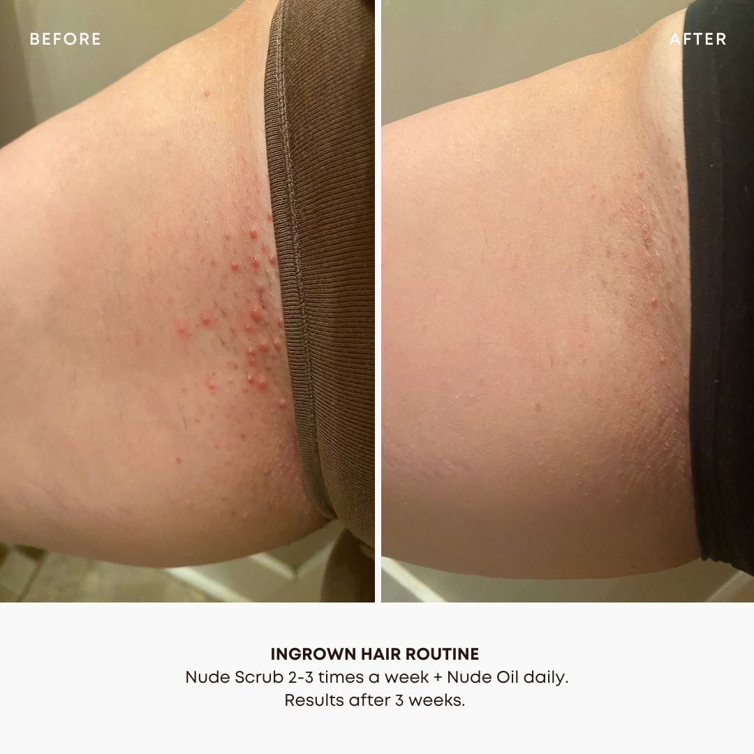 Nude Ingrown Hair 2 Step Routine