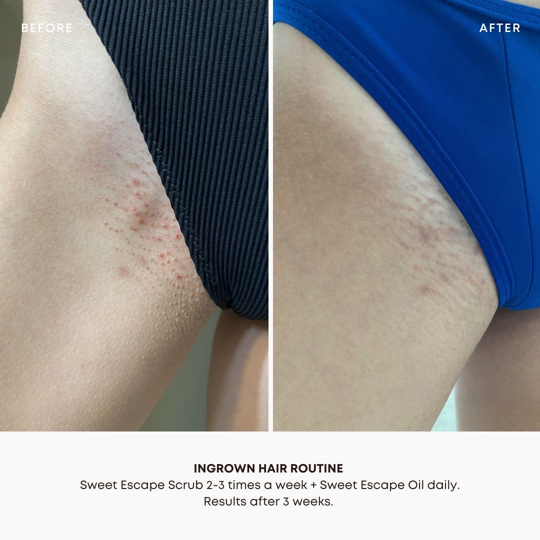 Bump Free Bundle