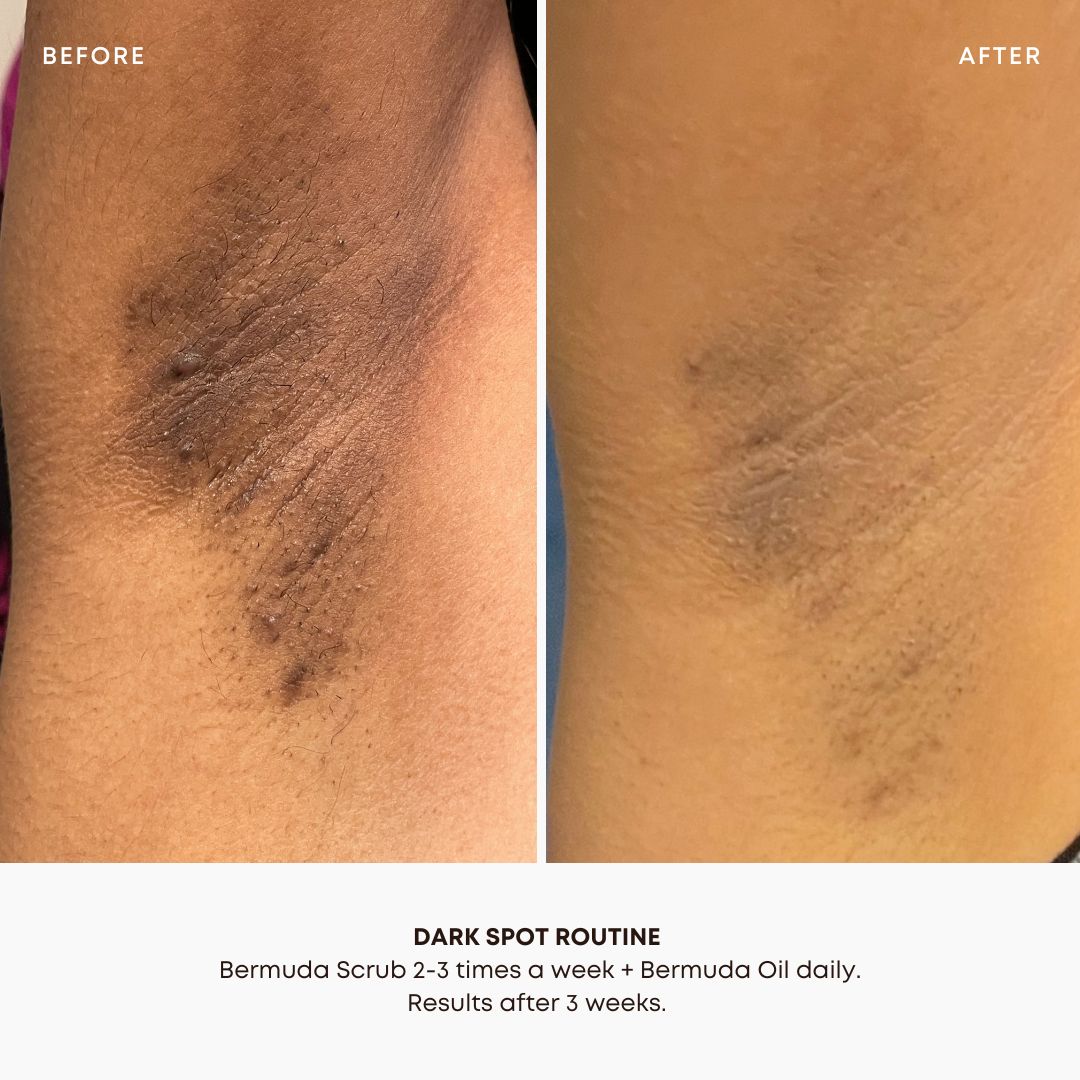 Bermuda Dark Spot Oil 3 Pack