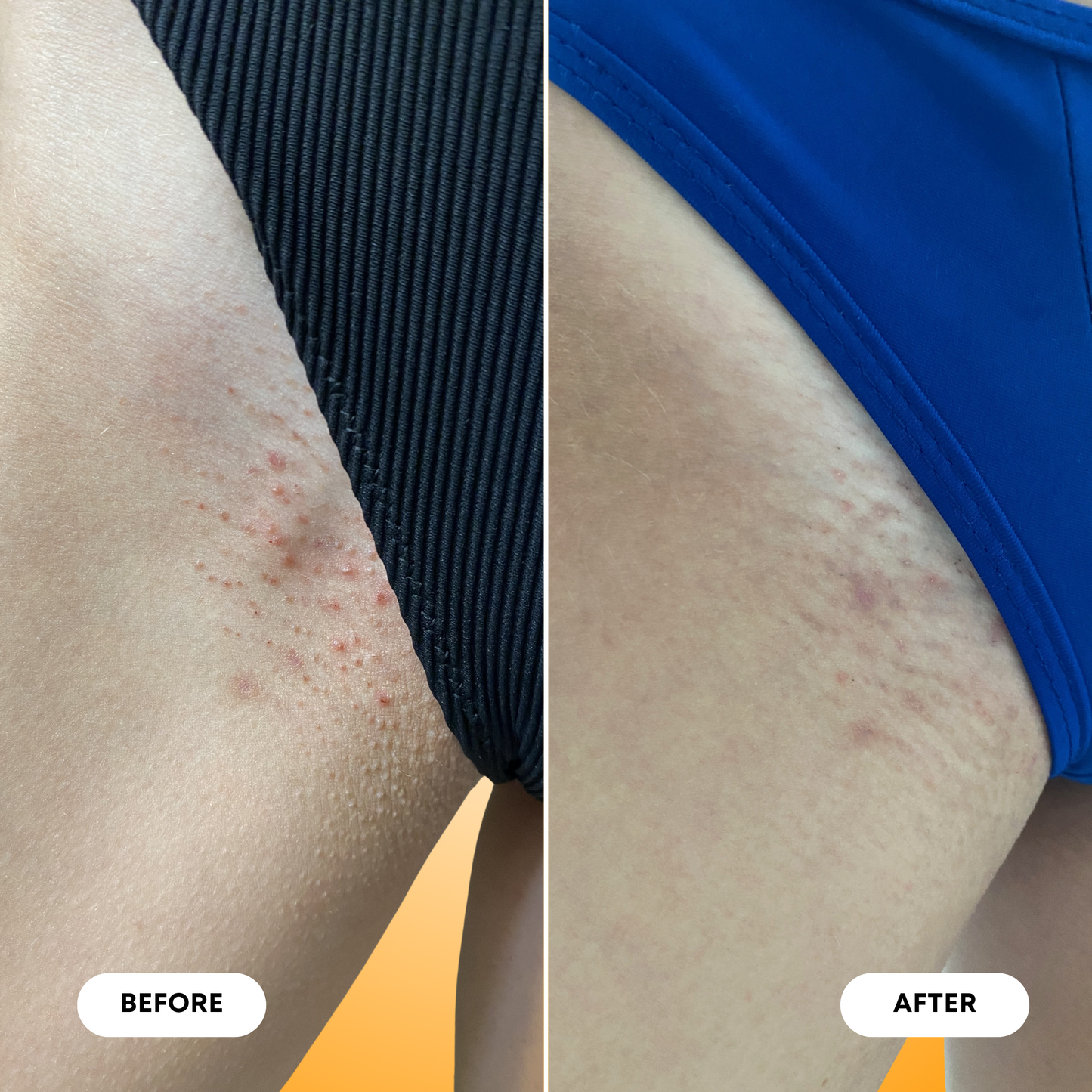 Vanilla Tangerine Ingrown Hair 2 Step Routine