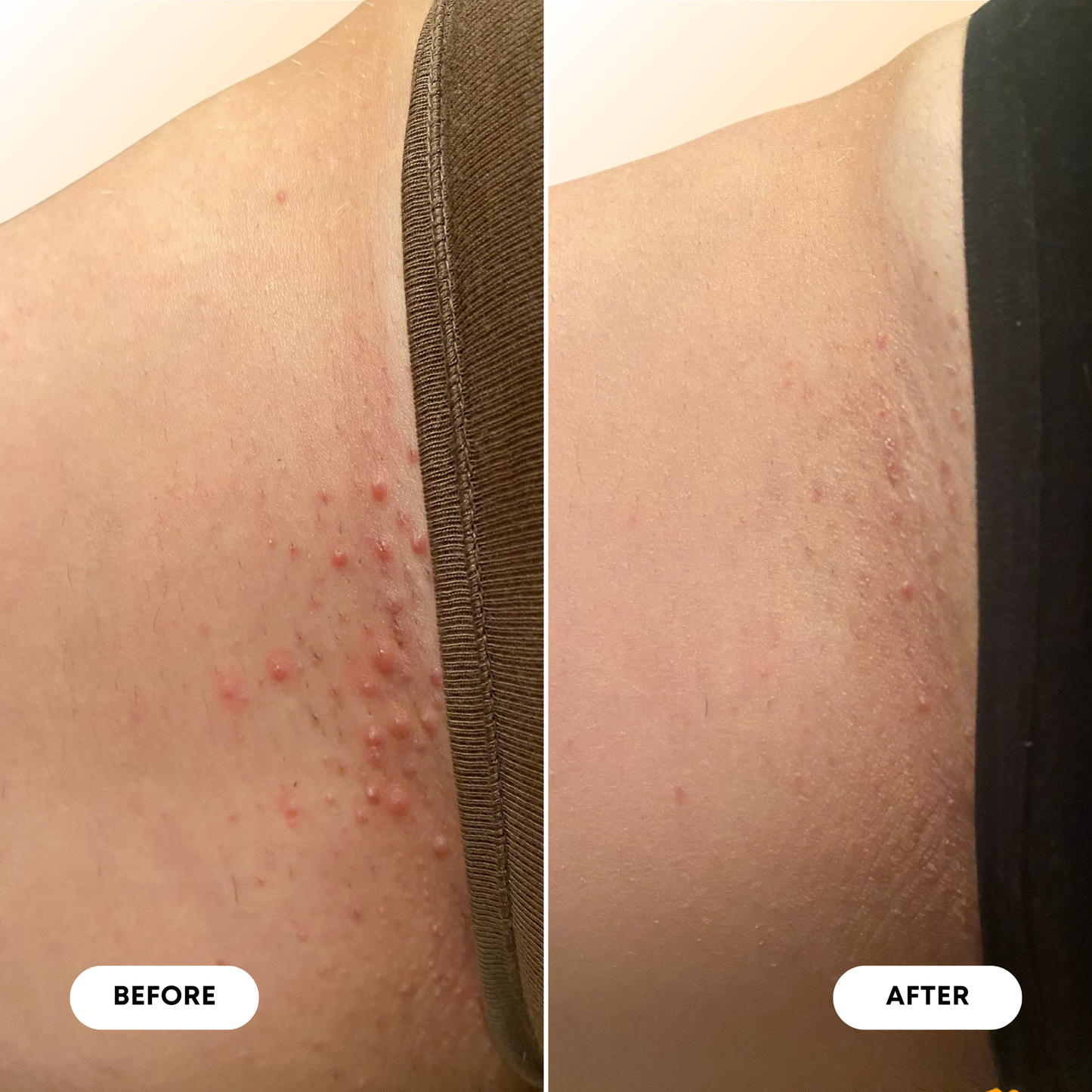 Vanilla Tangerine Ingrown Hair Oil