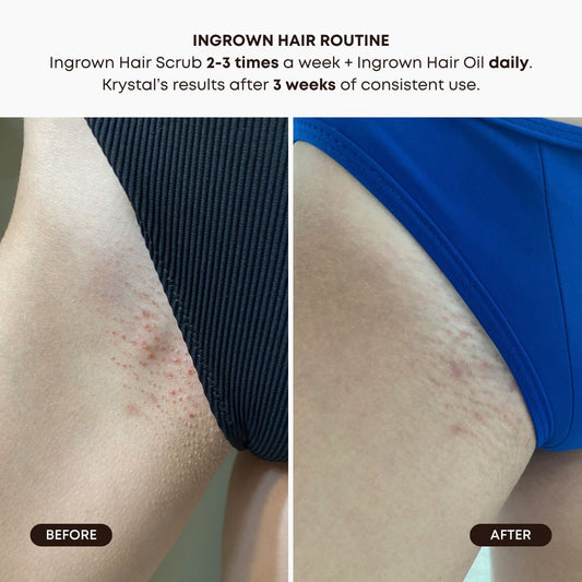 Watermelon Sugar Ingrown Hair Oil