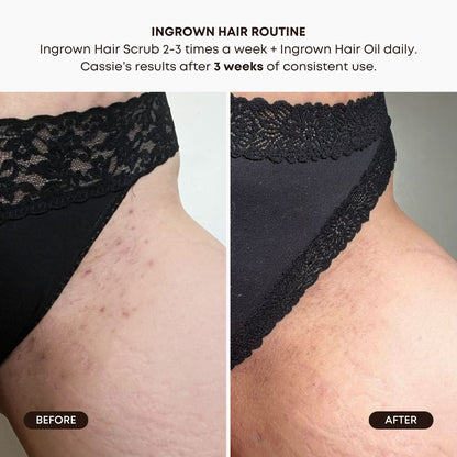 Watermelon Sugar Ingrown Hair Oil