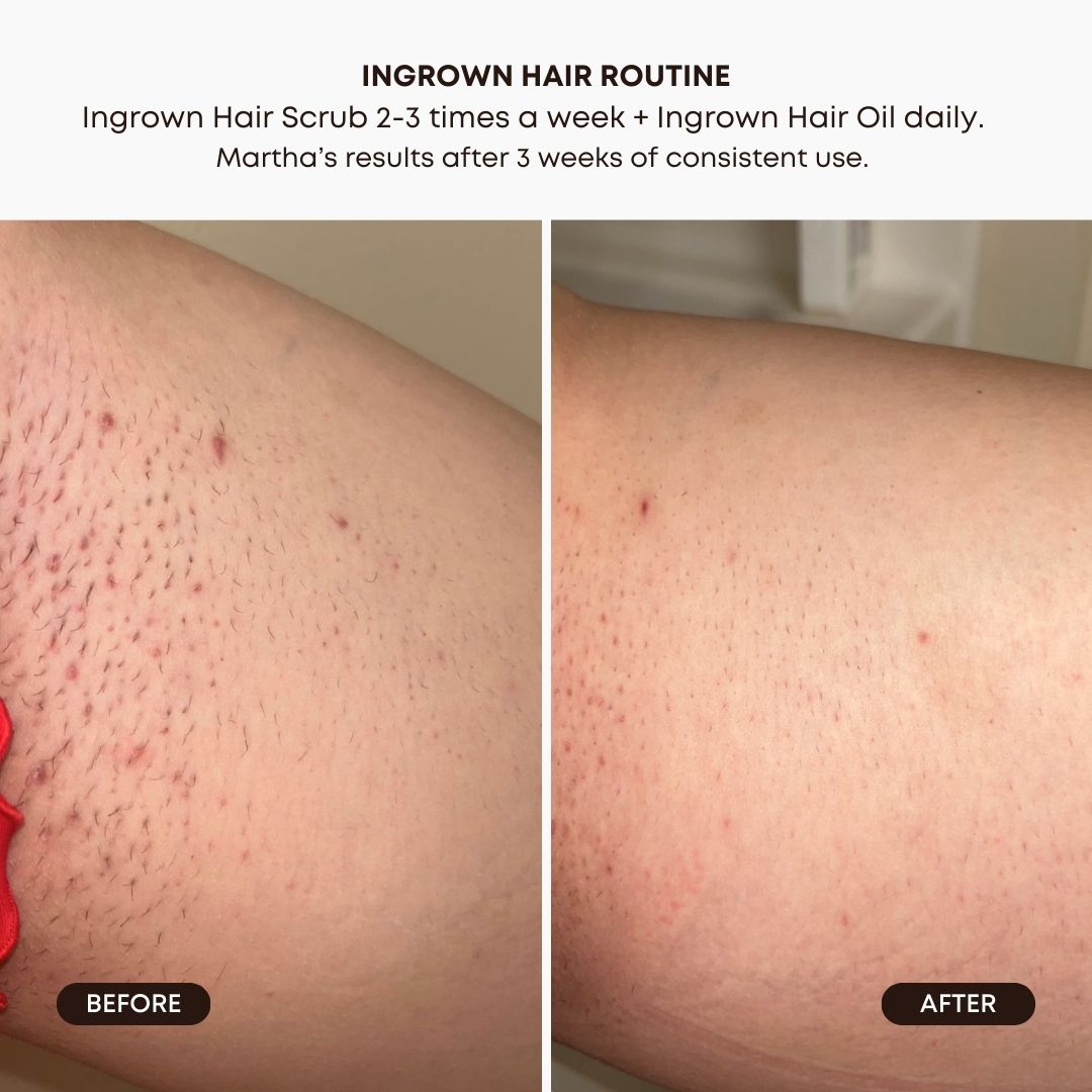 Watermelon Sugar Ingrown Hair 2 Step Routine