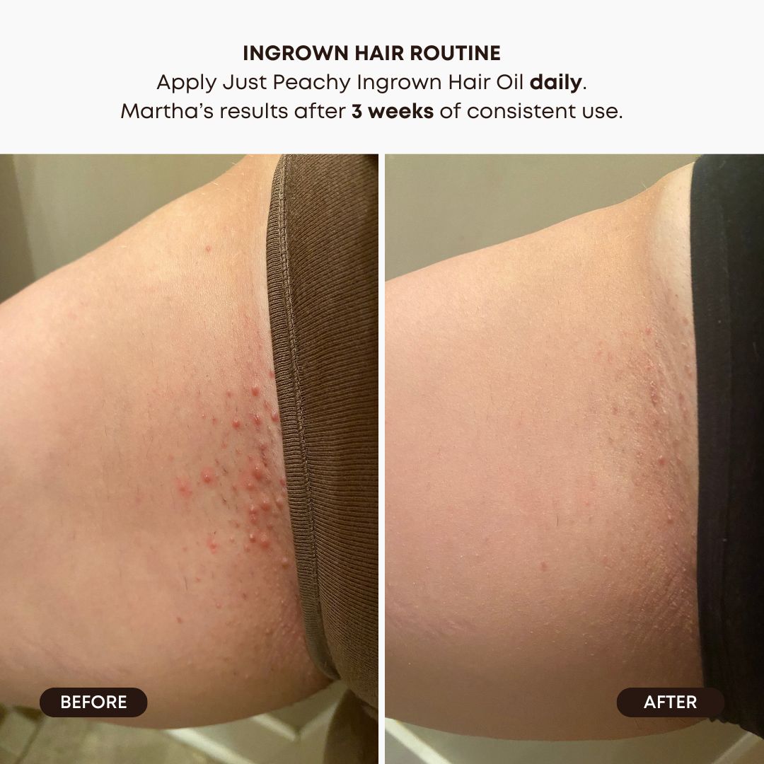 Watermelon Sugar Ingrown Hair 2 Step Routine